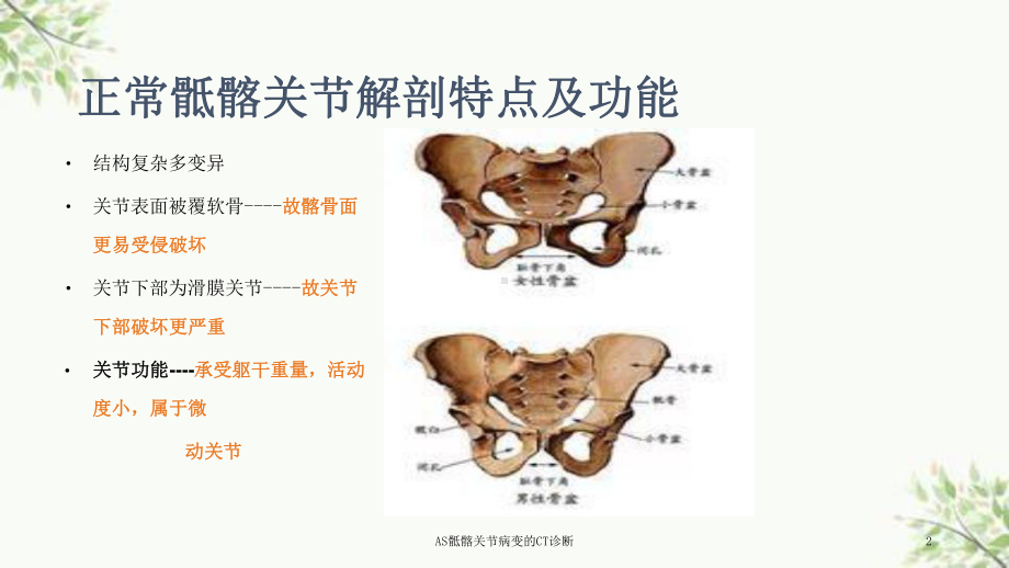 AS骶髂关节病变的CT诊断课件.ppt_第2页