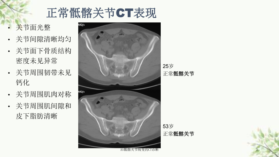 AS骶髂关节病变的CT诊断课件.ppt_第3页