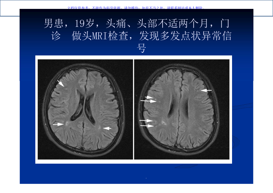 TCD发泡实验在神经内科疾病中应用的典型病例析课件.ppt_第1页