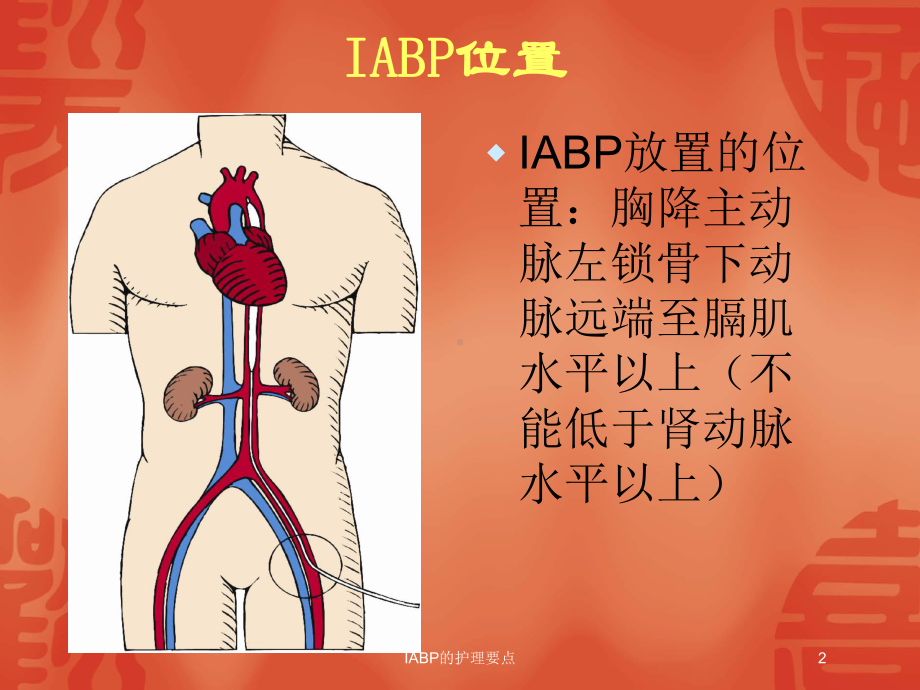 IABP的护理要点培训课件.ppt_第2页