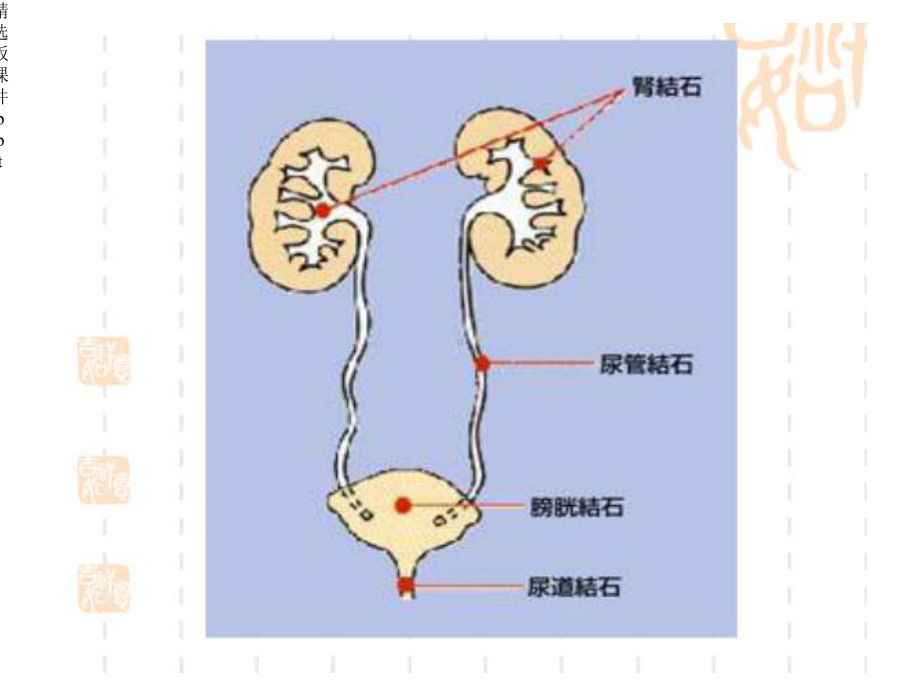 膀胱结石的护理课件.ppt_第3页