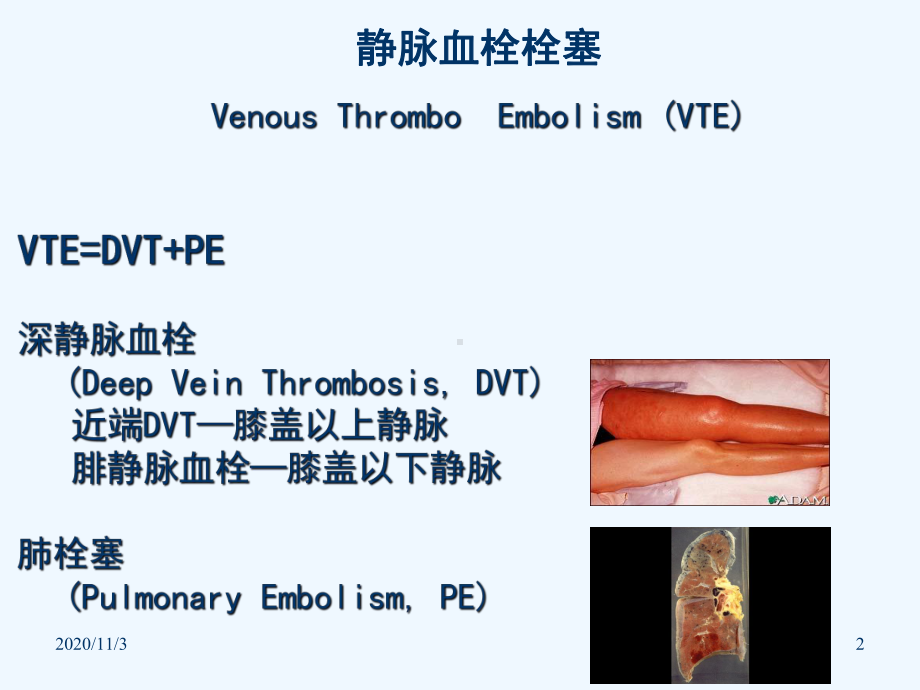 ICU深静脉血栓预防课件.ppt_第2页