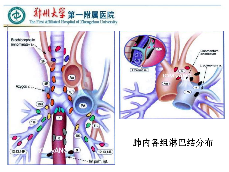 VATS左侧肺癌根治术中的淋巴结清扫主题讲座课件.ppt_第1页