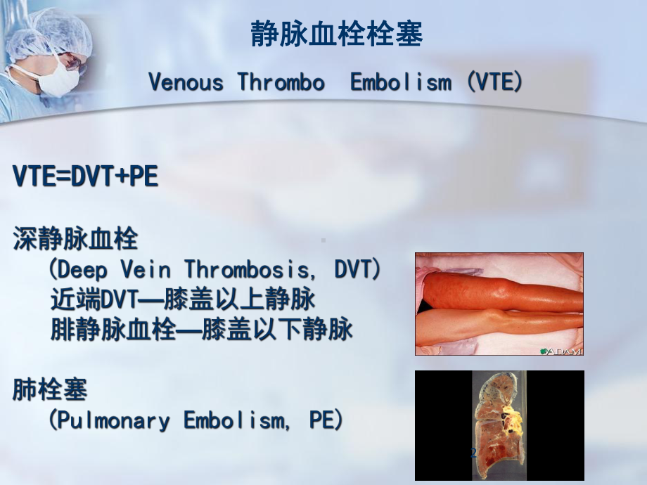 ICU深静脉血栓的预防解析课件.pptx_第2页