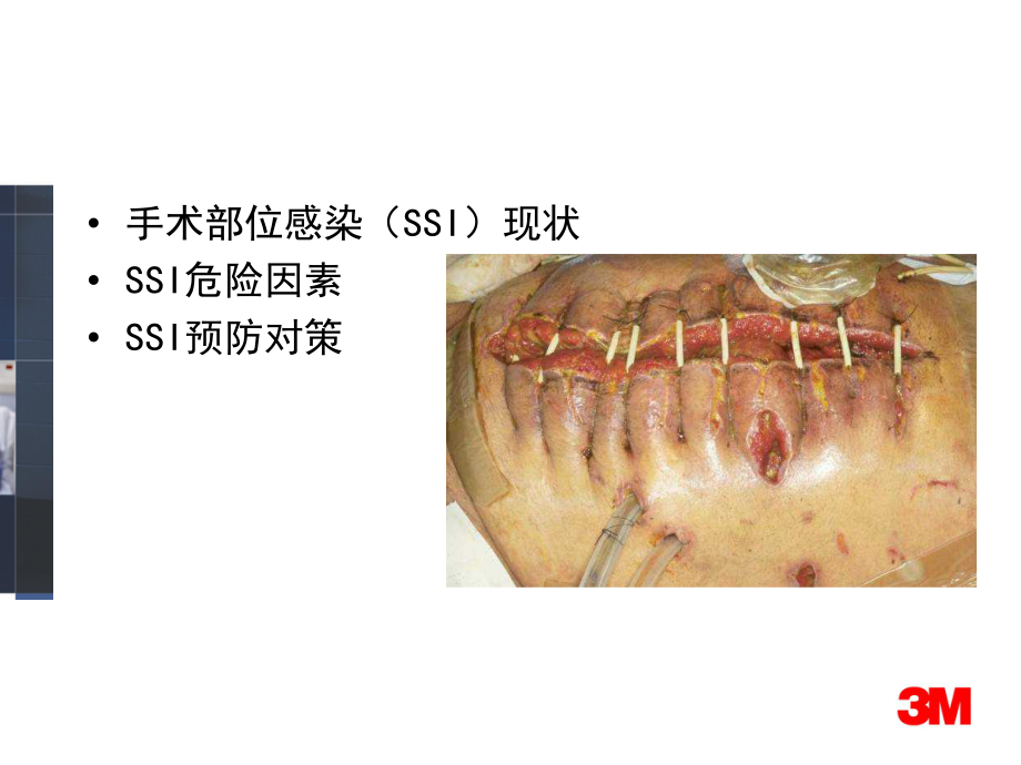 SSI危险因素与预防措施y医院感染管理科课件.pptx_第3页