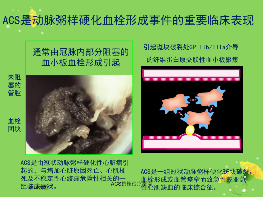 ACS抗栓治疗指南培训课件.ppt_第1页