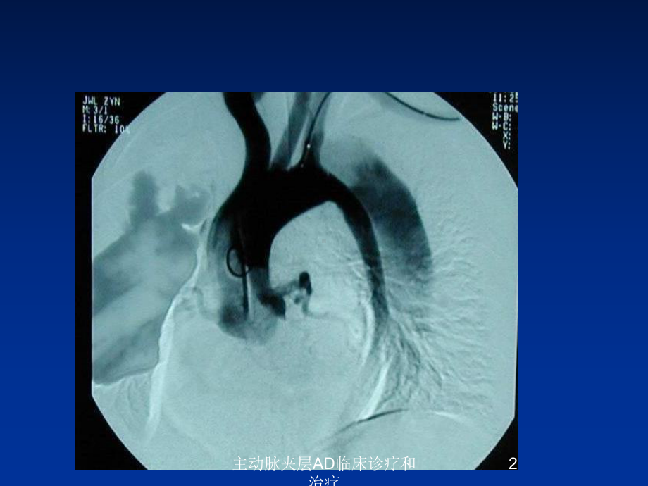 主动脉夹层AD临床诊疗和治疗培训课件.ppt_第2页