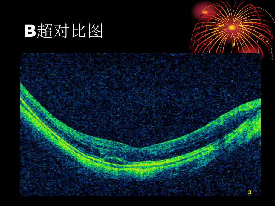 OCT的应用及检查1课件.ppt_第3页