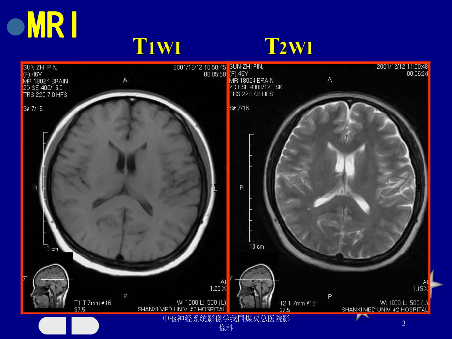 中枢神经系统影像学我国煤炭总医院影像科培训课件.ppt_第3页