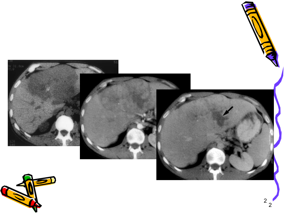 FNH影像诊断及鉴别诊断课件.ppt_第2页