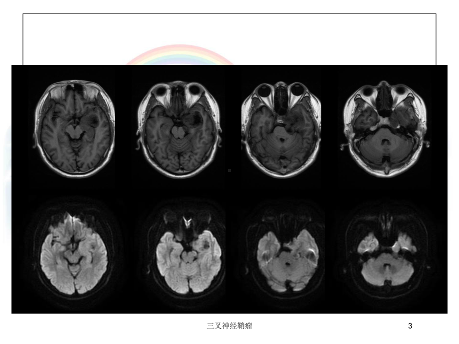 三叉神经鞘瘤培训课件.ppt_第3页