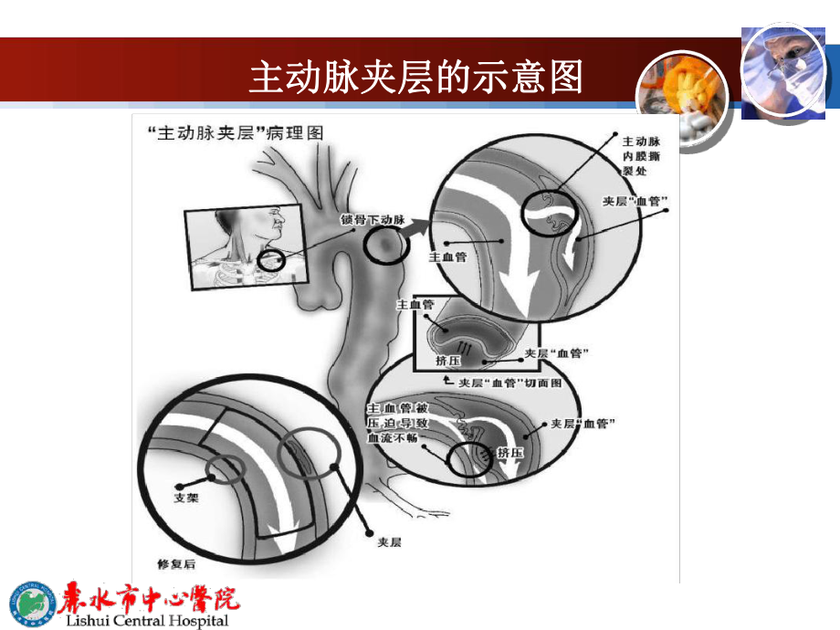 主动脉夹层急诊诊断2课件.ppt_第3页