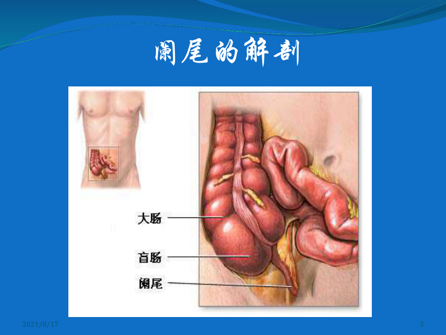 《急性阑尾炎》课件.ppt_第3页