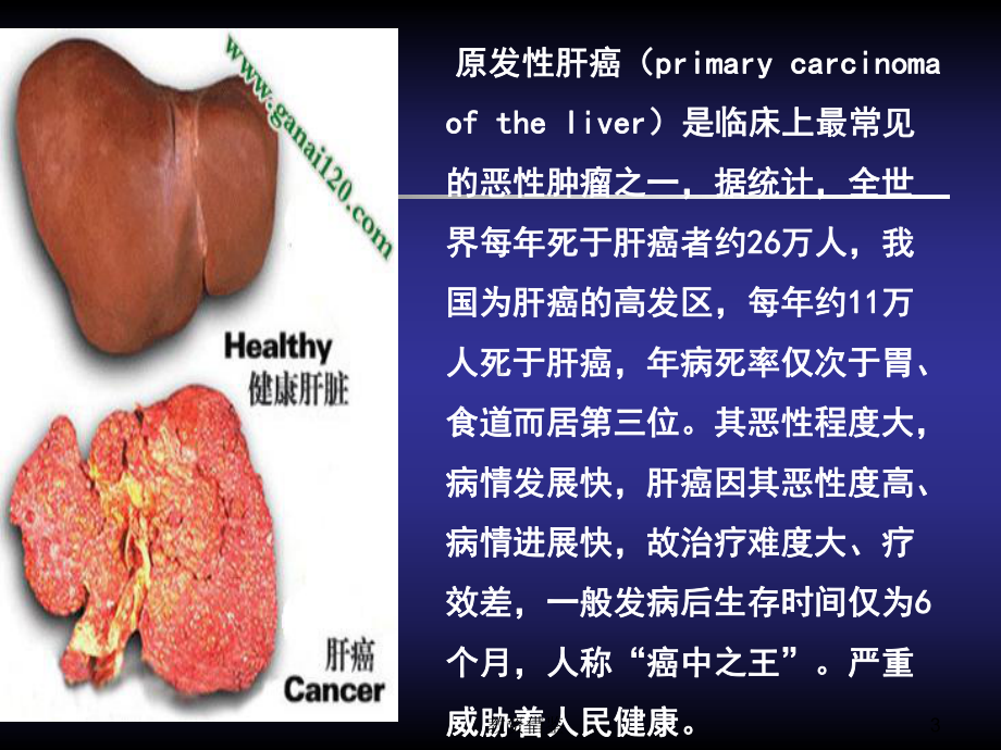 125I放射性粒子治疗肝癌(教资优择)课件.ppt_第3页