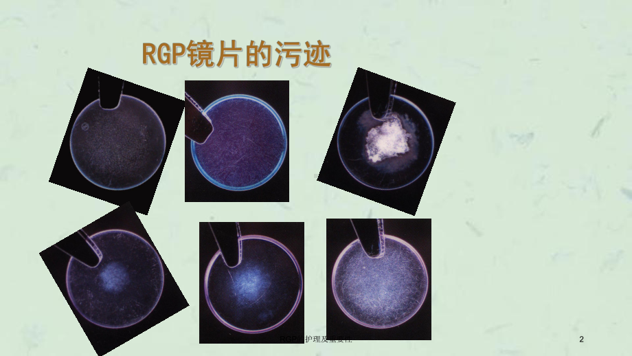 RGP的护理及重要性课件.ppt_第2页