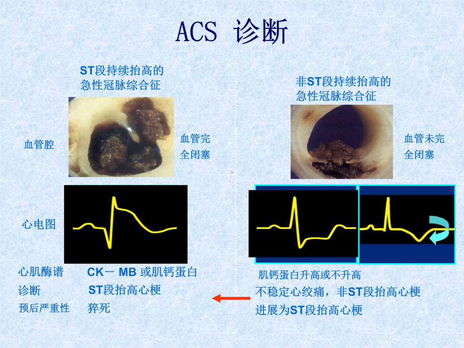 NSTEACS的诊断和治疗课件.ppt_第3页