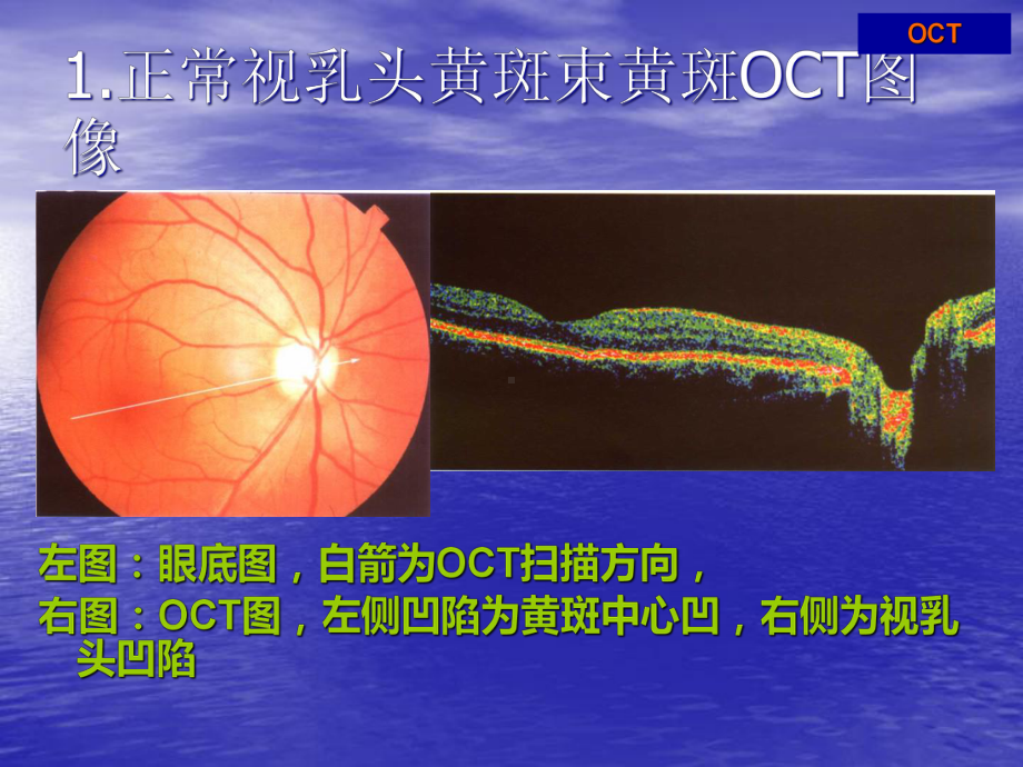 OCT结果解读课件.pptx_第2页