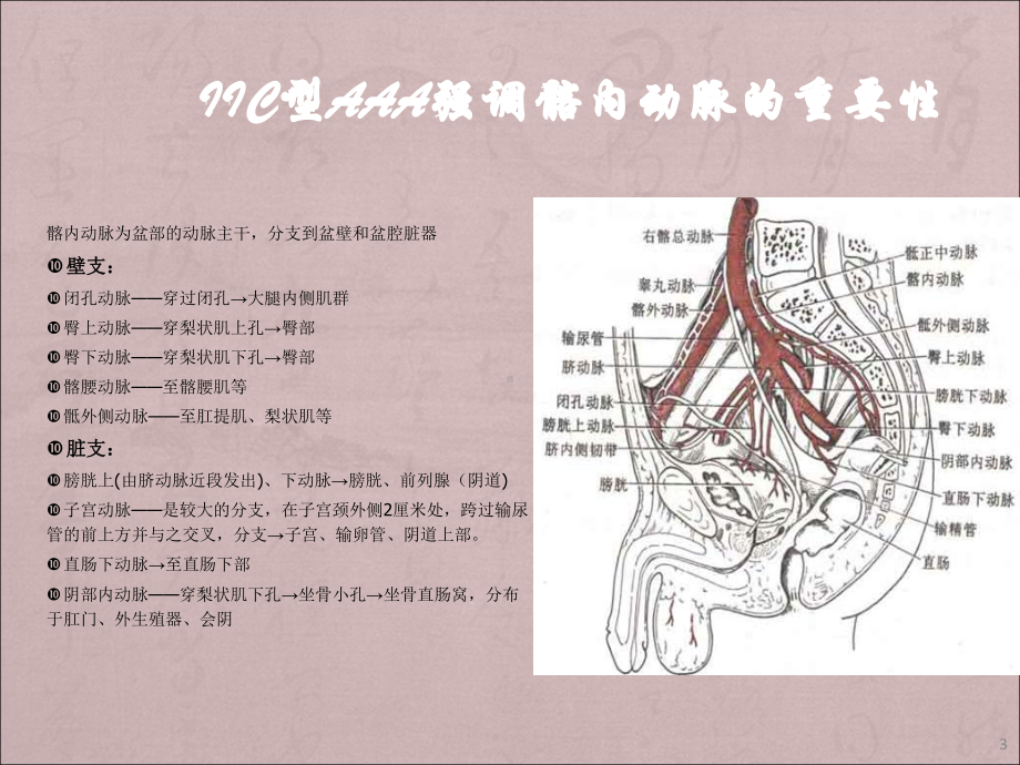 IIC腹主动脉瘤腔内修复中髂内动脉的处理课件.ppt_第3页