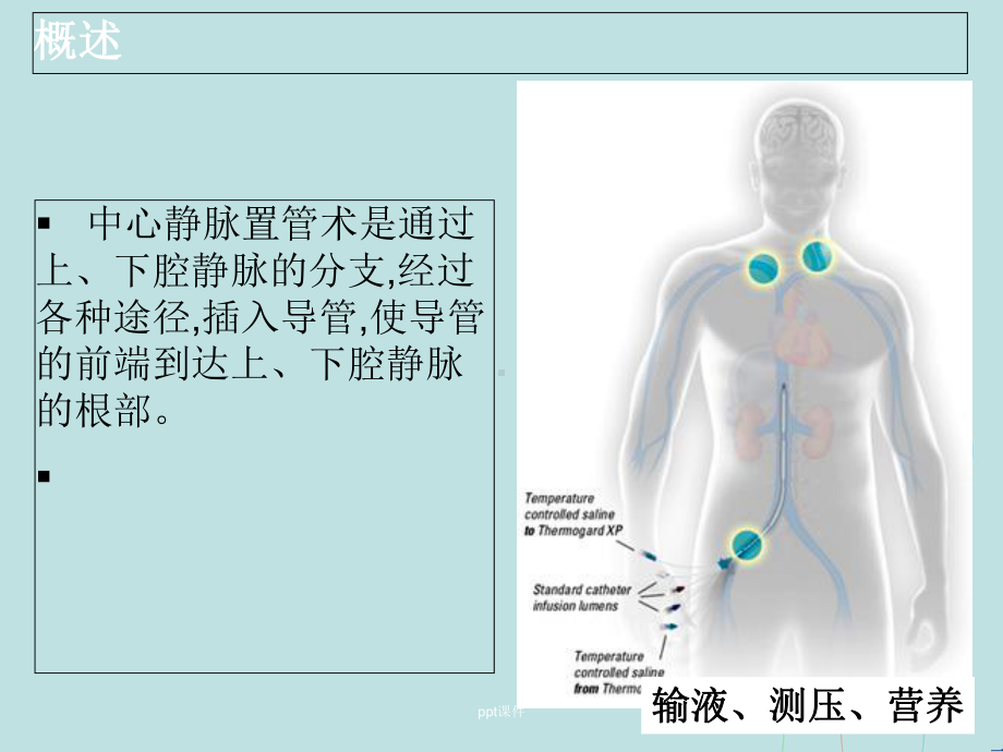 中心静脉置管术的相关知识及护理-课件.ppt_第2页