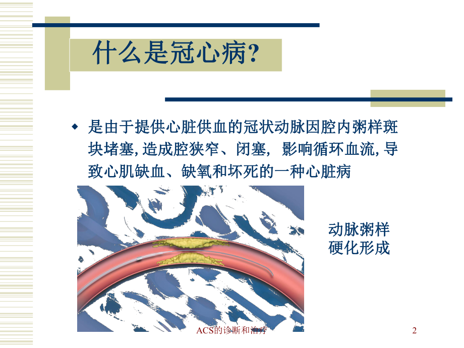 ACS的诊断和治疗培训课件.ppt_第2页