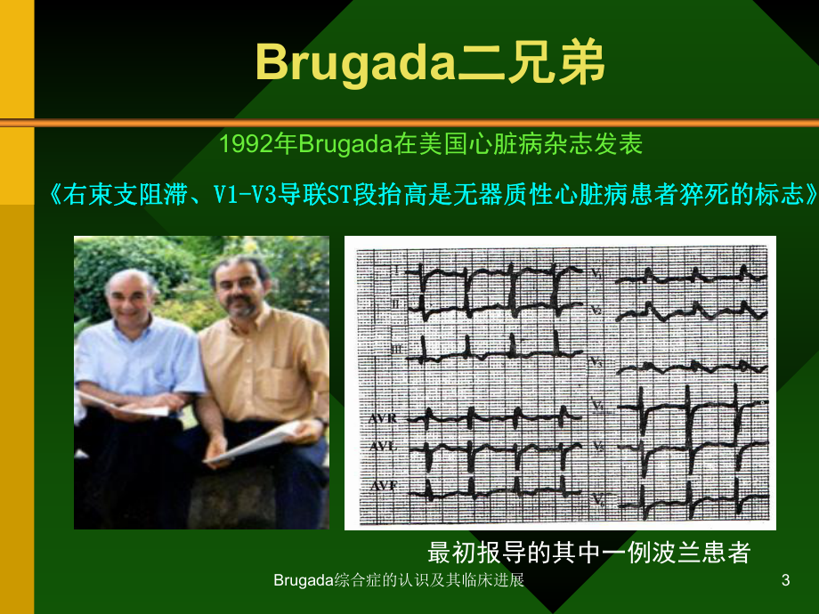 Brugada综合症的认识及其临床进展课件.ppt_第3页