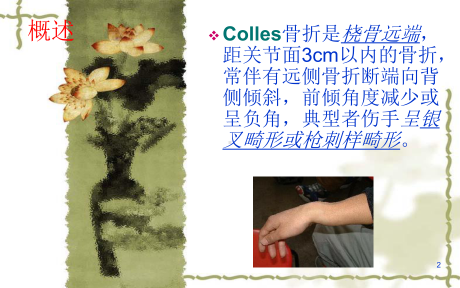 colles骨折培训课件.ppt_第2页