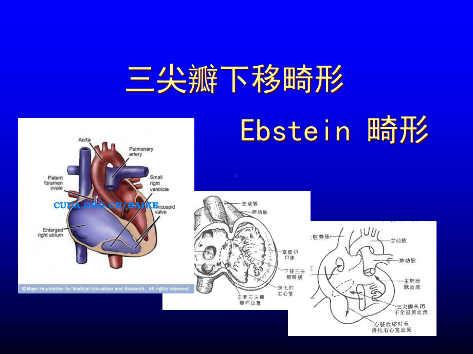 三尖瓣下移畸形-ebstein-anomaly-课件.ppt_第1页