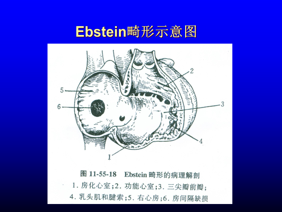 三尖瓣下移畸形-ebstein-anomaly-课件.ppt_第3页