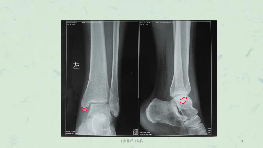 下胫腓联合损伤课件.ppt_第3页