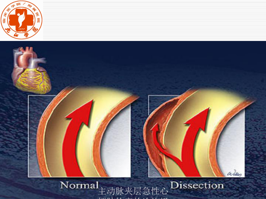 主动脉夹层急性心梗肺栓塞的诊治极极实用宣教培训课件.ppt_第2页