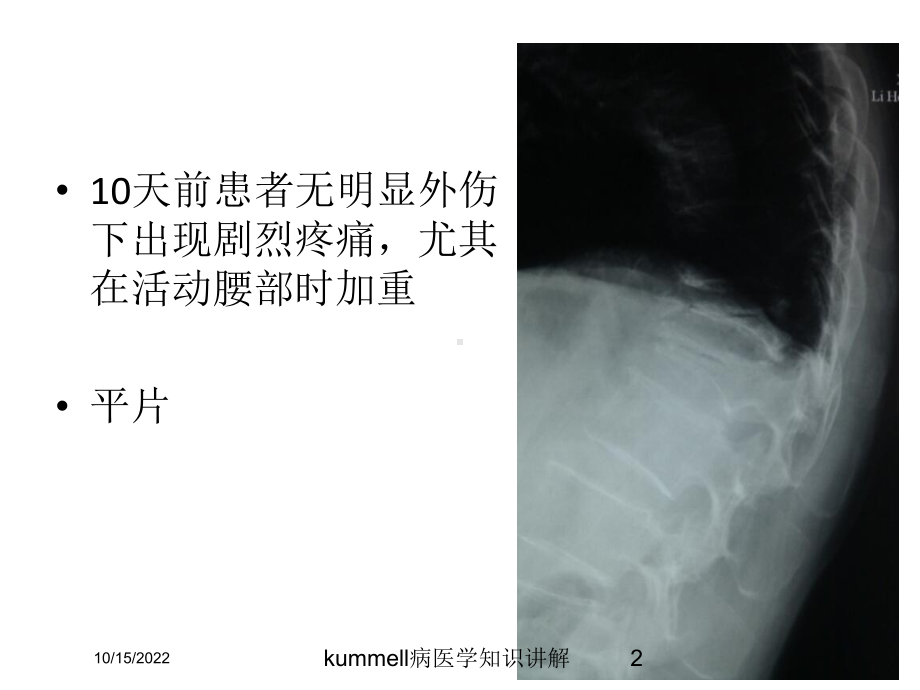 kummell病医学知识讲解课件.ppt_第2页