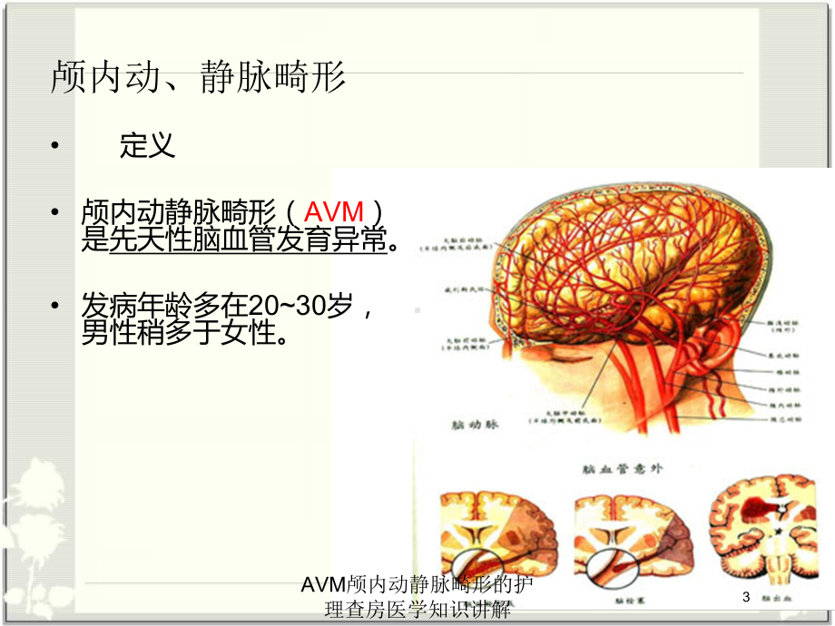 AVM颅内动静脉畸形的护理查房医学知识讲解培训课件.ppt_第3页