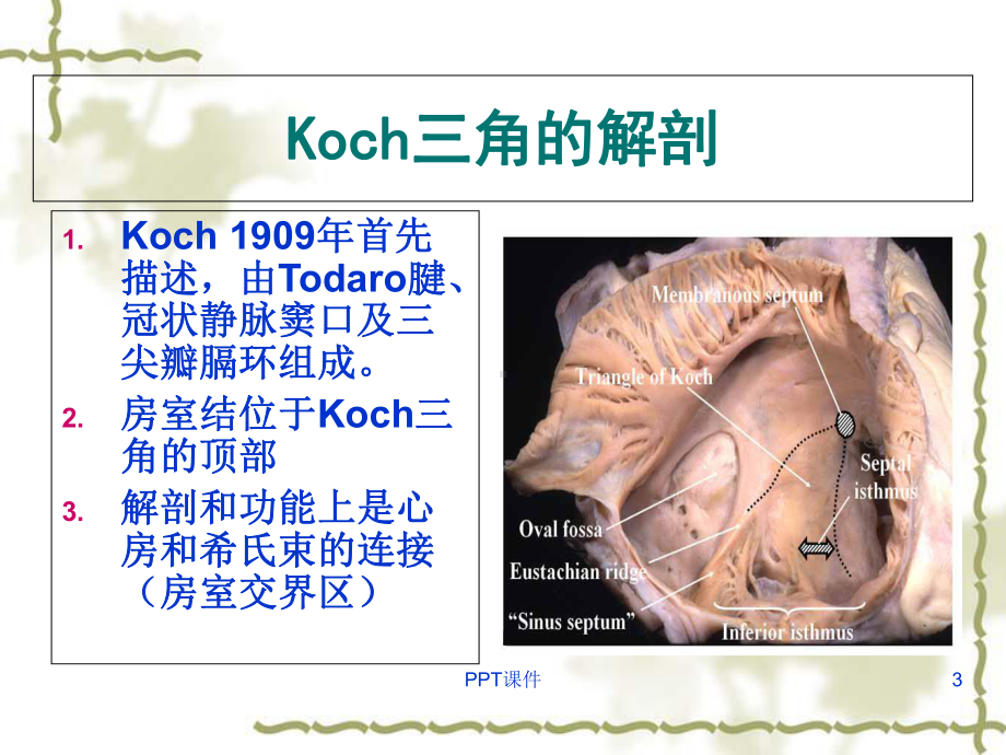 Koch-三角解剖与临床-课件.ppt_第3页