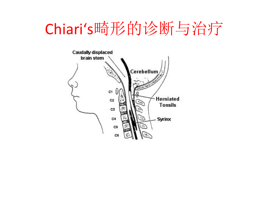 chiari畸形的诊断与治疗课件-2.ppt_第1页