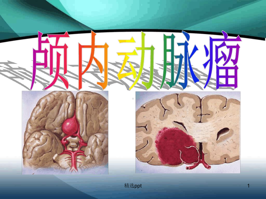 颅内动脉瘤介入术后的护理课件.ppt_第1页