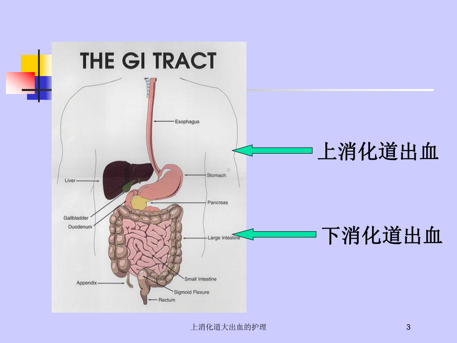 上消化道大出血的护理培训课件.ppt_第3页