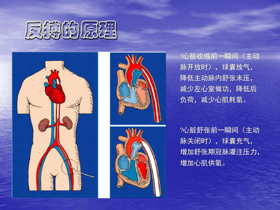 主动脉内球囊反搏泵概述及使用简介2课件.ppt_第3页