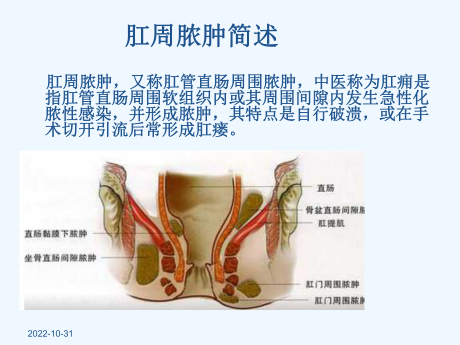 一例肛周脓肿术后换药个案课件.ppt_第2页