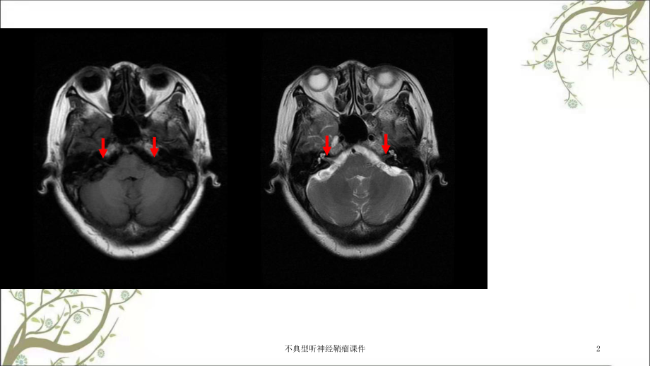 不典型听神经鞘瘤课件.ppt_第2页