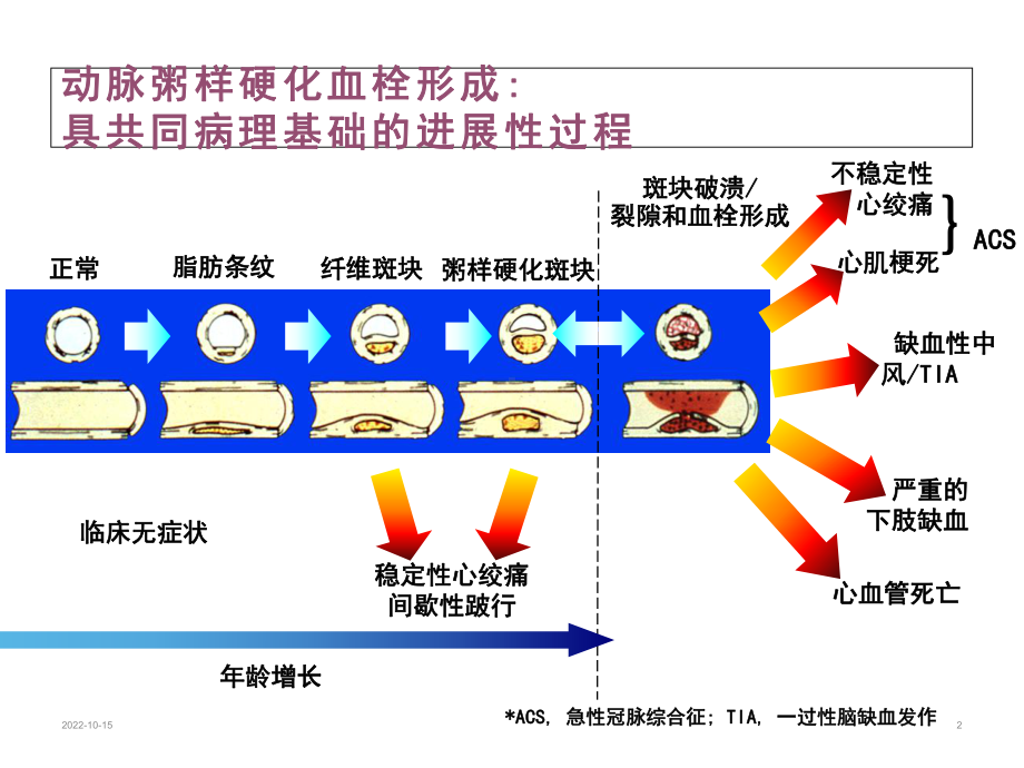 不稳定心绞痛-医药类课件.ppt_第2页