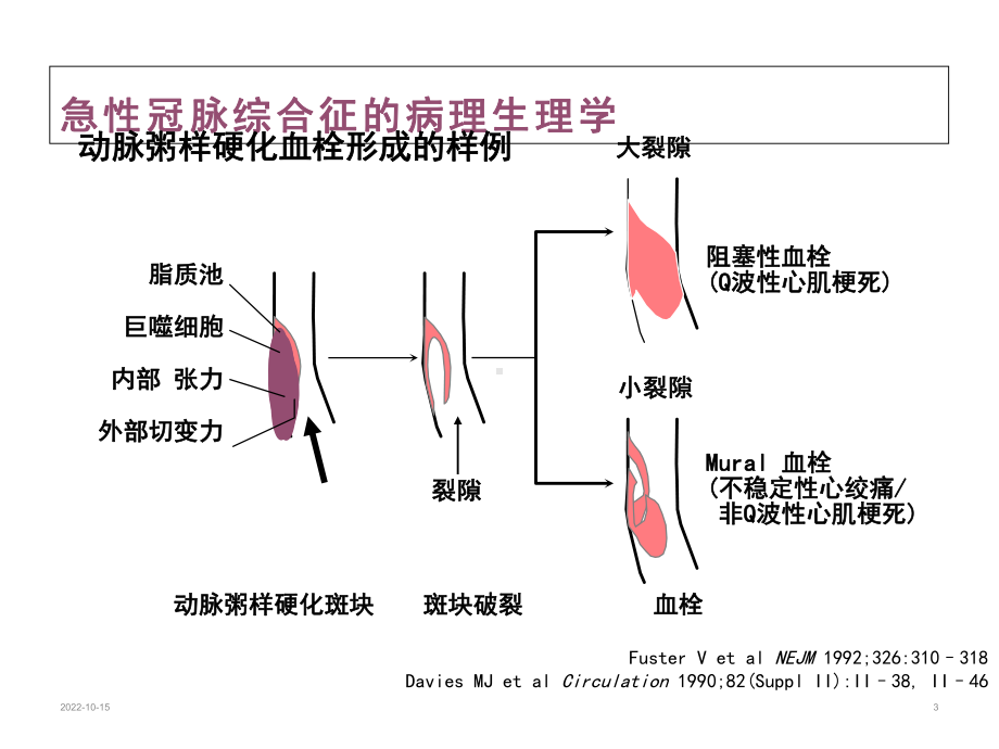 不稳定心绞痛-医药类课件.ppt_第3页