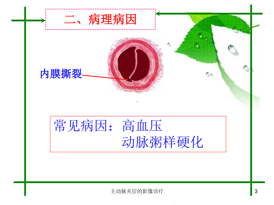 主动脉夹层的影像诊疗培训课件.ppt_第3页