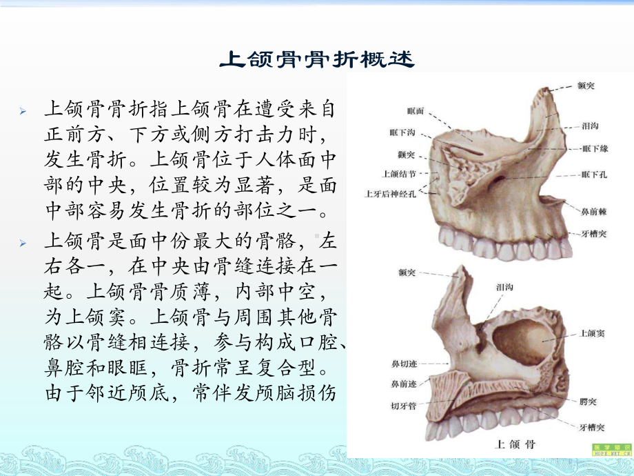 上下颌骨骨折课件.pptx_第3页