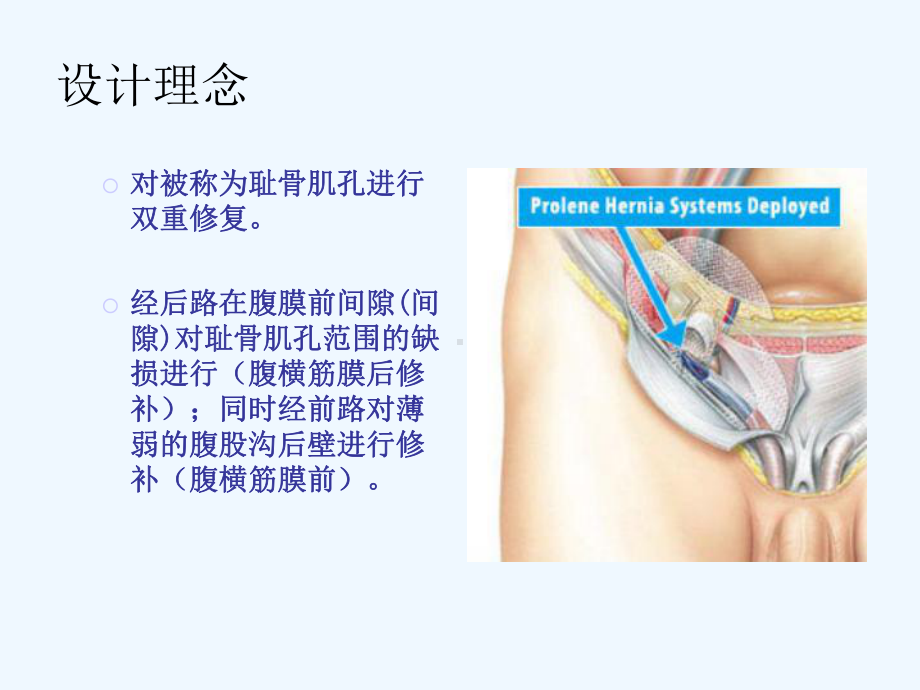 PHS在腹股沟疝修补手术中应用课件.ppt_第2页