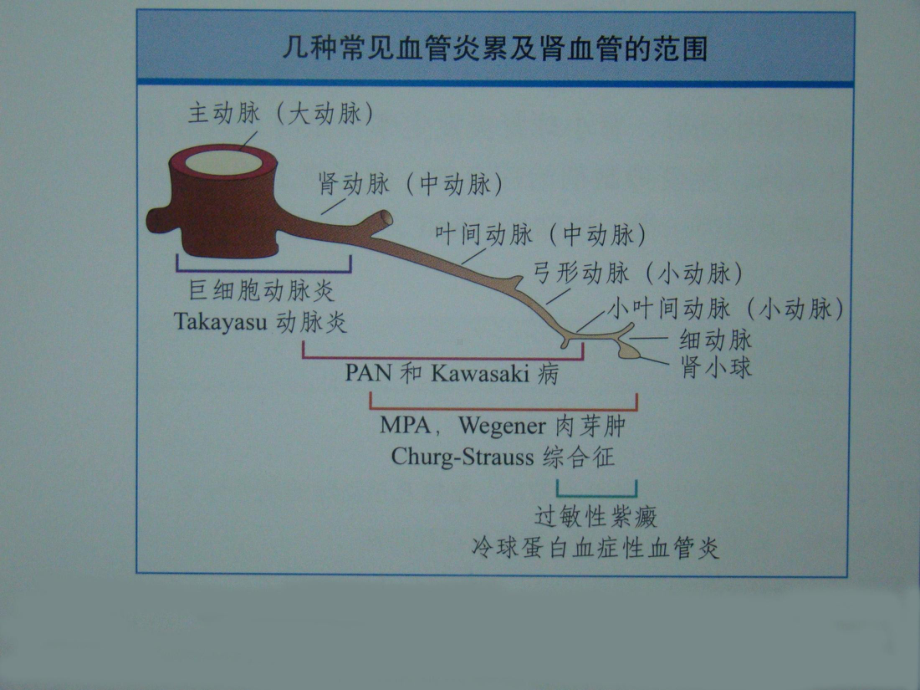 ANCA相关性血管炎诊疗进展培训课件.ppt_第3页