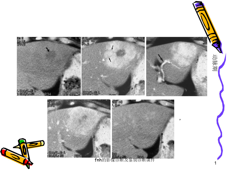 fnh的影像诊断及鉴别诊断课件.ppt_第1页