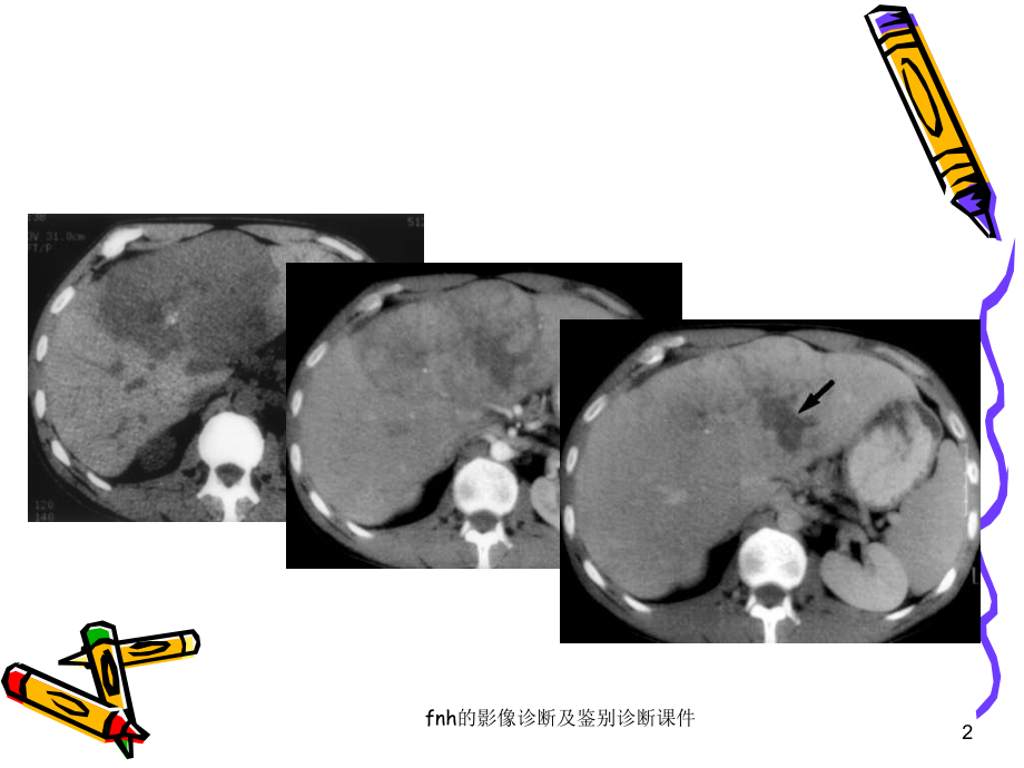 fnh的影像诊断及鉴别诊断课件.ppt_第2页