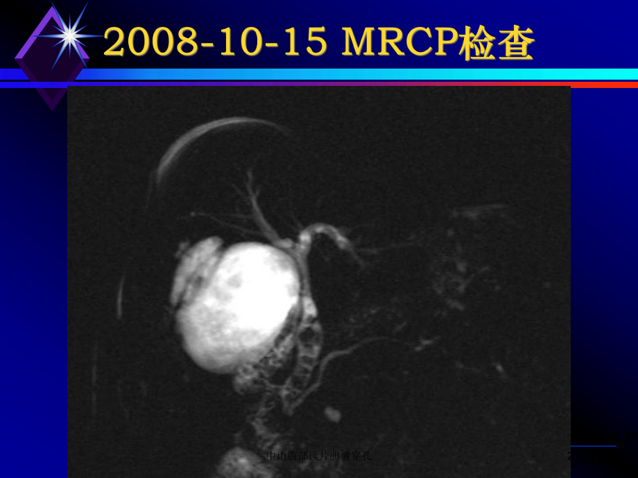 中山腹部读片胆囊穿孔培训课件.ppt_第2页