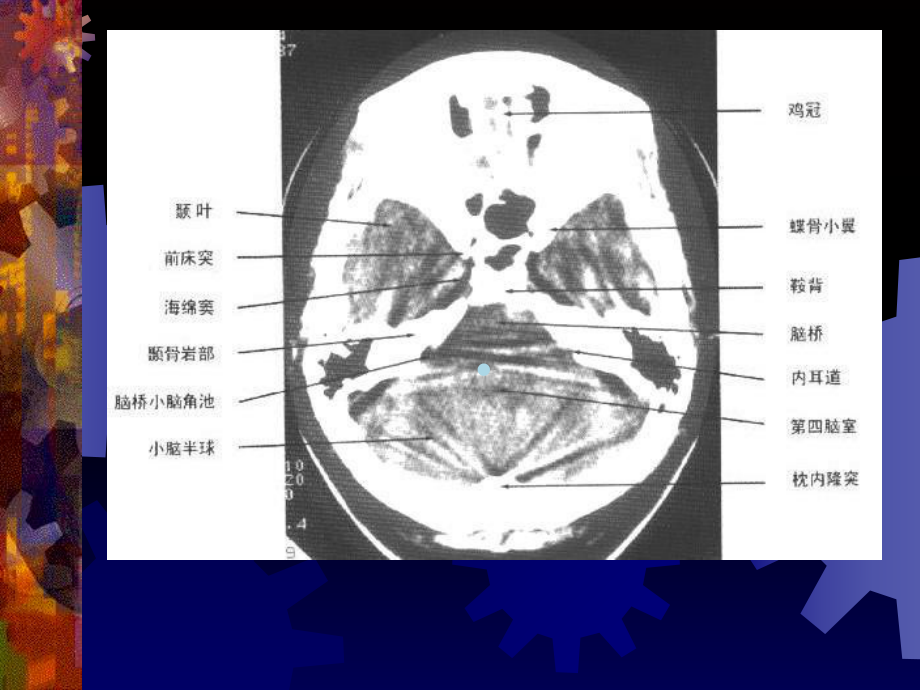 [医药卫生]正常头颅CT及MRI解剖课件.ppt_第3页