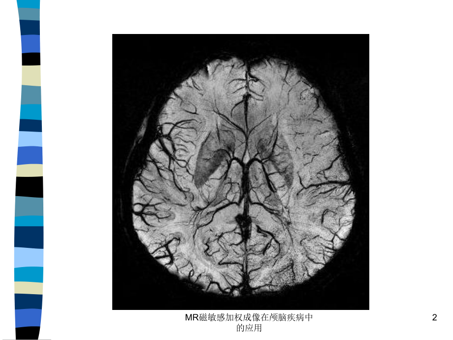 MR磁敏感加权成像在颅脑疾病中的应用课件.ppt_第2页